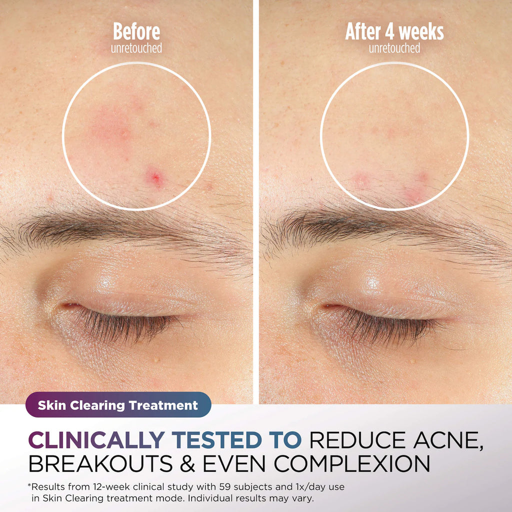 CryoGlow Cooling + LED Face Mask & Facial Glo Skin Tool